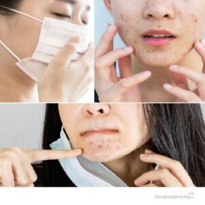 Cách chăm sóc da mụn khi đeo khẩu trang